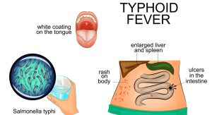 Symptoms of Typhoid Fever and How to Prevent it