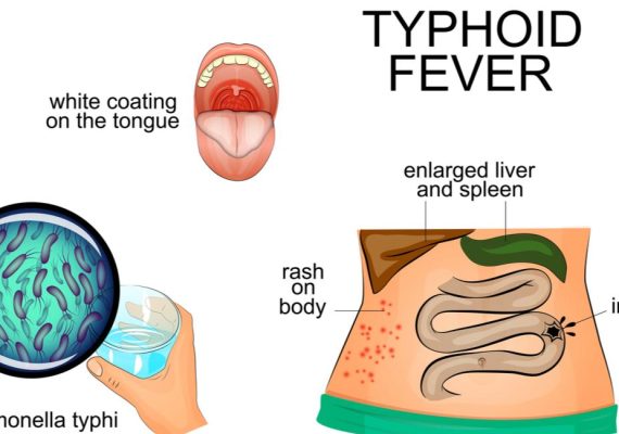 Symptoms of Typhoid Fever and How to Prevent it