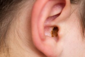 How to unblock ears full of wax with ear syringing - Miles Pharmacy