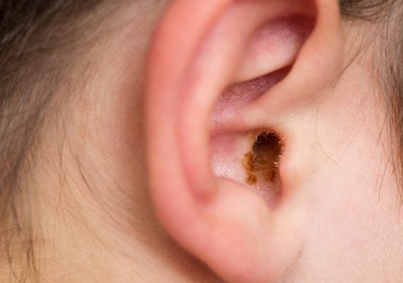 How to unblock ears full of wax with ear syringing - Miles Pharmacy