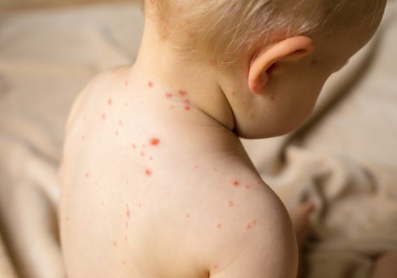 Summertime Chickenpox: Symptoms, Treatment, and Care