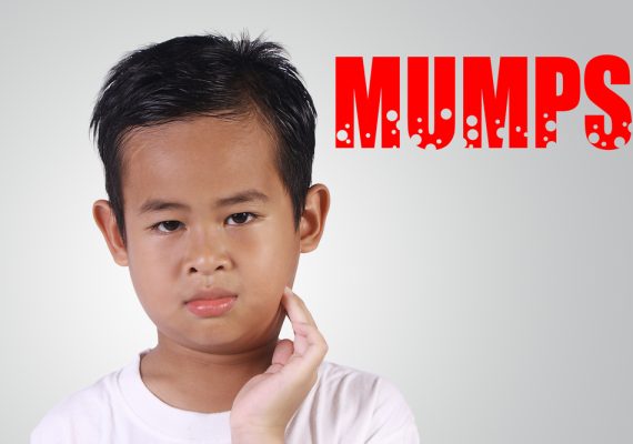 Mumps Outbreaks: What You Need to Know