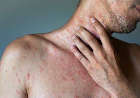 Miles Pharmacy's Guide to Chickenpox Vaccination for Men